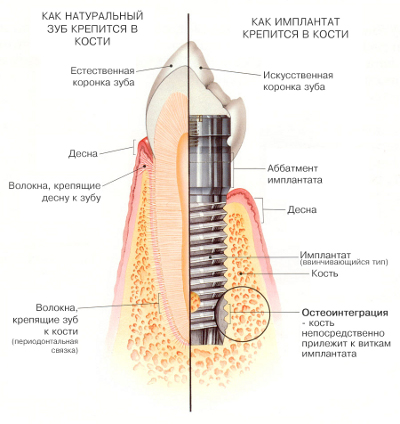 Зубной имплантат