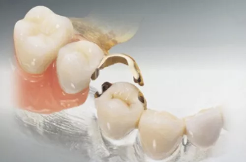 Микропротезы зуба